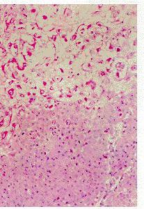 增生性外毛根鞘瘤