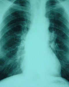 肺鈣化灶 肺鈣化灶