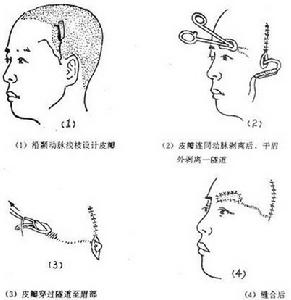 眉再造手術操作圖