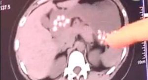 CT中難以融化的小顆粒陰影