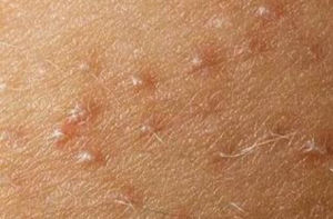 毛囊角質化 毛囊角質化