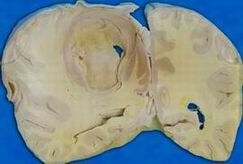 肺炎克雷白桿菌肺炎