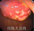 大腸埃希桿菌性胃腸炎