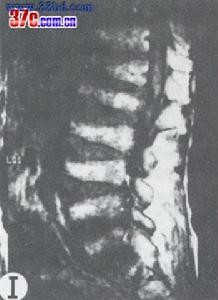 多發性骨骺發育不良
