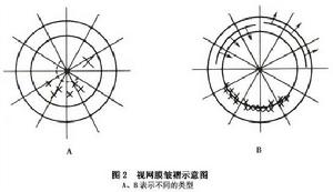 增生性玻璃體視網膜病變