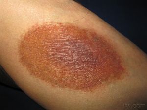 小兒過敏性紫癜腎炎 小兒過敏性紫癜腎炎