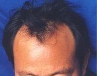 脂溢性脫髮 脂溢性脫髮