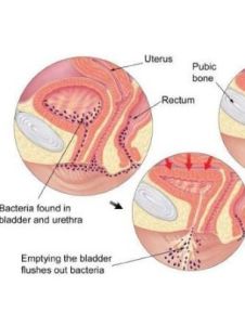 出血性膀胱炎 出血性膀胱炎