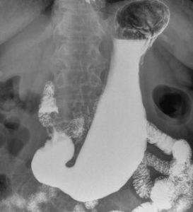 十二指腸淤積症 十二指腸淤積症