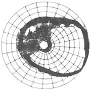 原發性開角型青光眼