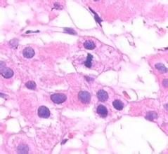 先天性肝纖維化 先天性肝纖維化