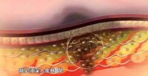 8層淨斑 8層淨斑