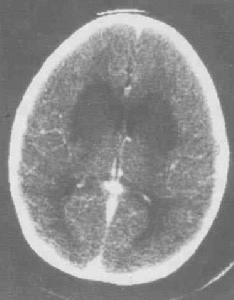 小兒病毒性腦炎