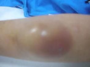 皮下脂質肉芽腫病 皮下脂質肉芽腫病