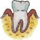 牙齒感覺過敏症