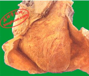 圖8 纖維素性心包炎