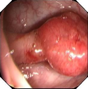 乙狀結腸息肉 乙狀結腸息肉