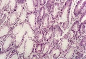 脂肪纖維瘤 脂肪纖維瘤