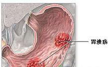 兒童期消化性潰瘍 兒童期消化性潰瘍