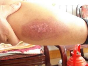 深二度灼傷 深二度灼傷