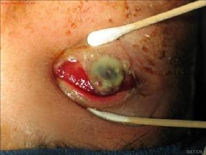 綠膿桿菌性角膜潰瘍