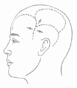腦損傷后綜合征