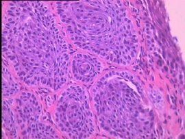 非典型鱗狀細胞