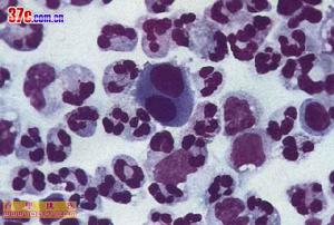 淋巴細胞脈絡叢腦膜炎