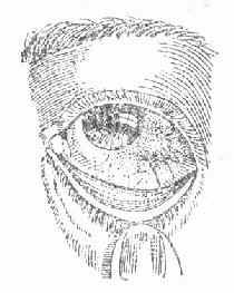 表層鞏膜炎 表層鞏膜炎