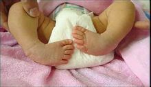 先天性內翻足 先天性內翻足