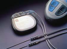 骶神經刺激器 骶神經刺激器