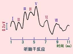 腦幹聽覺誘發電位