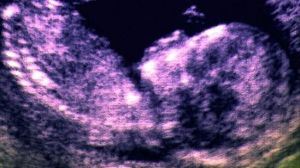 產前基因療法 產前基因療法