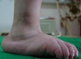 仰趾外翻 仰趾外翻