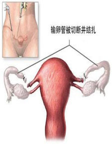 女性結紮手術 女性結紮手術