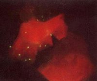 兒童支原體感染