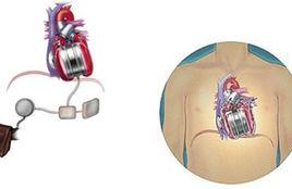 人工血泵 人工血泵