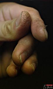 左揚民打工受傷的手