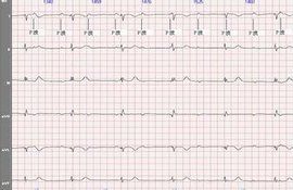 心臟停搏 心臟停搏