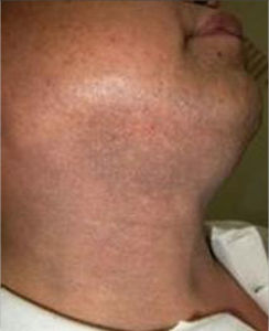 皮膚黑變病 皮膚黑變病