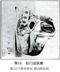 先天性肛門直腸畸形