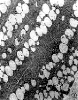 脂質沉積性肌病