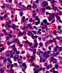 淋巴結反應性增生