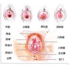 處女膜修補 處女膜修補