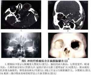 眼部神經纖維瘤病