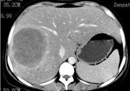 肝糖原累積症 肝糖原累積症