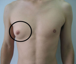 男性乳腺增生 男性乳腺增生