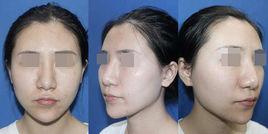 鼻頭肥大 鼻頭肥大