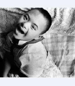 小兒弱智 小兒弱智