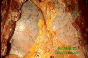 塵蟎過敏性哮喘